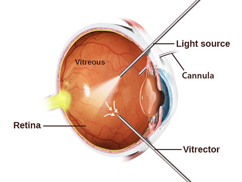 Vitrectomy
